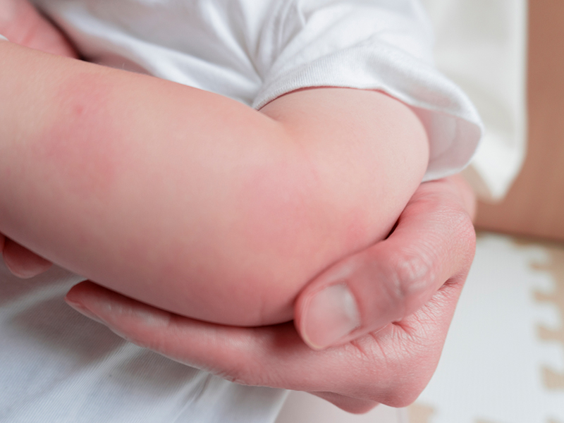 アトピー性皮膚炎